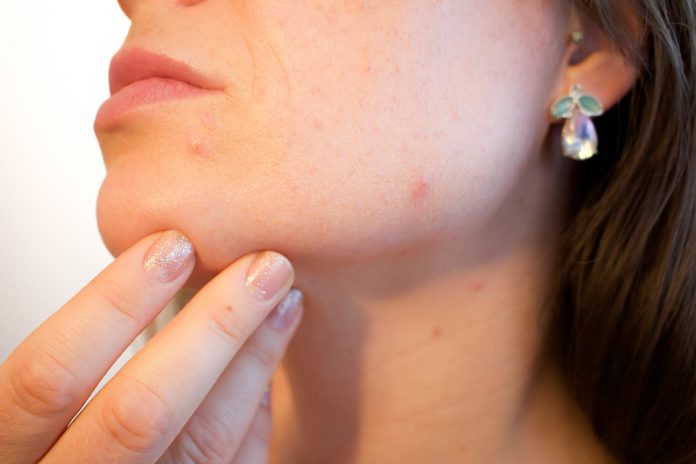 Here's How You Can Treat Menopause-Related Acne